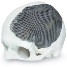 Image - Patients Now Benefit from Customized, 3D Printed Titanium Implants Used in Brain and Facial Surgeries